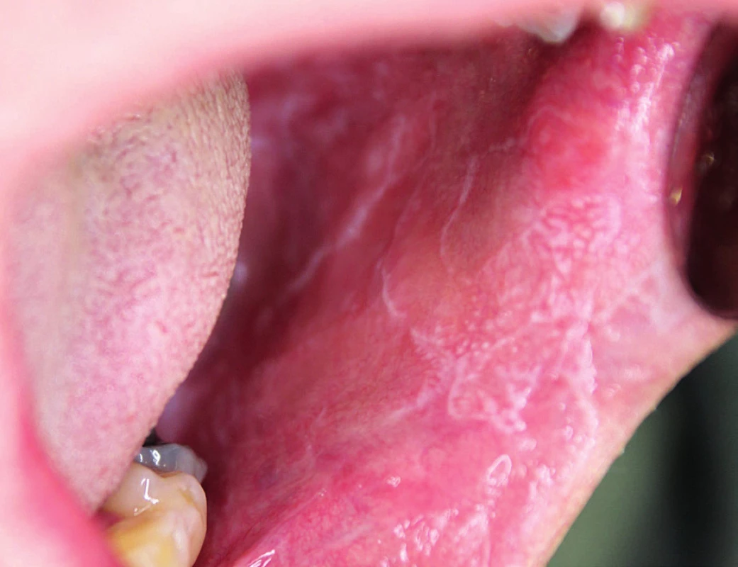 Orální lichen planus – retikulární forma