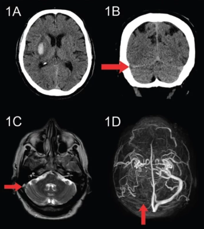 (A) Vstupní CT – axiální rovina, hyperdenzní hematom vpravo v oblasti capsula externa s hypodenzním perifokálním edémem. (B) Vstupní CT – koronální rovina, vpravo hypodenzní sinus transversus (šipka). (C) MR, T2 sekvence – axiální rovina, absence fl ow void fenoménu v pravém sinus sigmoideus (šipka). (D) MRA intrakraniálních žilních splavů, pohled shora; vlevo normální plnění sinus transversus a sigmoideus, vpravo tyto splavy uzavřené (šipka).