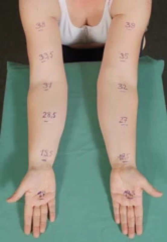 Mild lymphedema of left upper limb after axillary dissection.