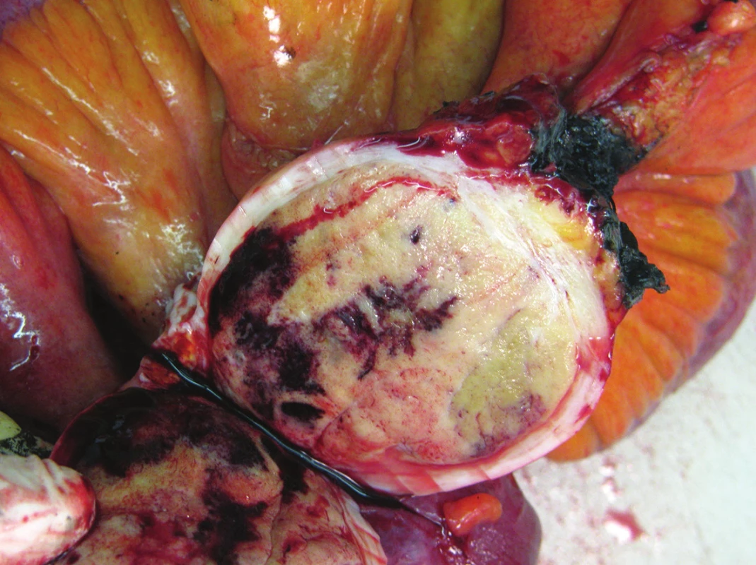 Neuroendokrinní tumor ilea
Fig. 2: Neuroendocrine tumor of the ileum