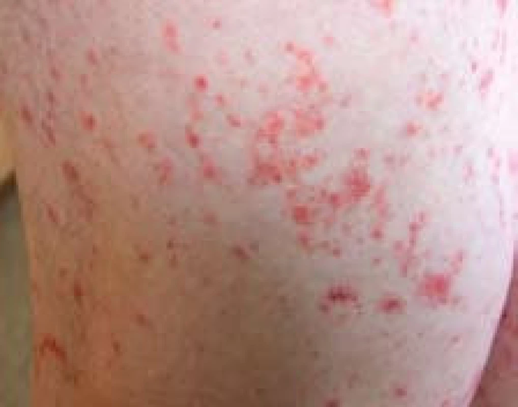 Henoch-Schönleinova purpura na stehně.
Fig 2. Henoch-Schönlein purpura in the thigh.
