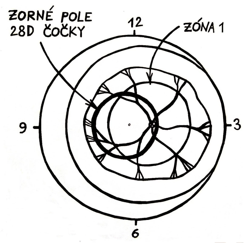 Zorné pole 28 D čočky: Máme-li v okraji zorného pole 28D čočky nazální okraj terče zrakového nervu a vidíme-li současně v celé ploše tohoto zorného pole cévy, potom nemůže jít o ROP zóny 1