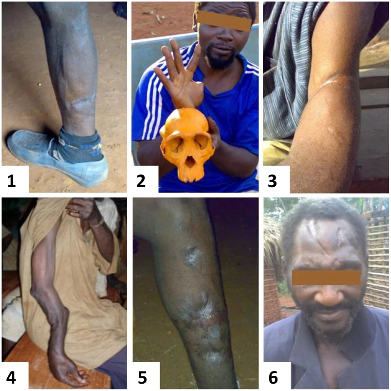 SFV infected individuals harboring scars and lesions caused by NHP bites.