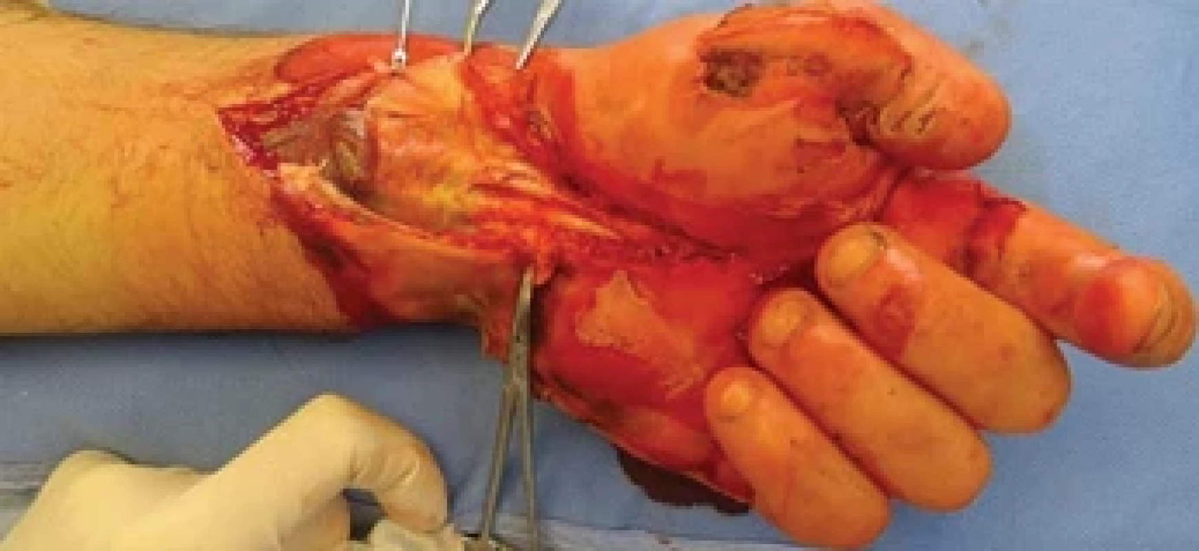 Left upper limb after necrectomy and fasciotomy.