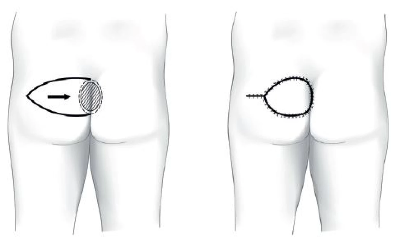 Sakrální dekubitus – fasciokutánní lalok V-Y
Fig. 2: Sacral pressure ulcer – fasciocutaneus V-Y advancement flap