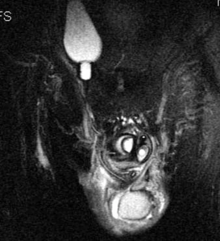 Penilní implantát, sagitální řez malou pánví. Je patrná rezervoár vedle měchýře, hadička, pumpa a nová „kavernózní“ tělesa.
