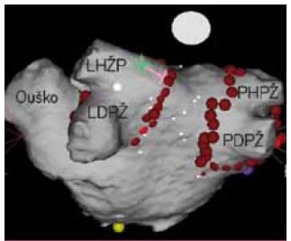 Široká antrální izolace plicních žil. Kolem stejnostranných žil je provedena kontinuální série ablačních lézí (červené body) s cílem dosažení izolace obou ipsilaterálních žil kontrolovanou pomocí cirkulárních mapovacích katetrů. Takto jsou eliminovány i spouštěče umístěné v antru plicních žil (zelená hvězdička). Pohled zezadu na 3D mapu levé síně vytvořenou systémem CARTO3 s integrací CT obrazu. LHPŽ – levá horní plicní žíla, LDPŽ – levá dolní plicní žíla, PHPŽ – pravá horní plicní žíla, PDPŽ – pravá dolní plicní žíla.