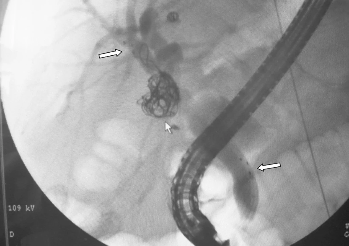 ERCP: stav po zavedení povlečeného metalického stentu do žlučových cest s překrytím ústí biliovaskulární píštěle. Velké šipky označují horní a dolní konec stentu (rentgen kontrastní tečky). Malá šipka v místě pseudovýdutě s coily.
Fig. 5. ERCP: status post introduction of the coated metallic stent into the bile ducts, with management of the biliovascular fistula. Big arrows mark the superior and inferior ends of the stent (x-ray contrast dotts). The small arrow points at the pseudoanerysm with coils.
