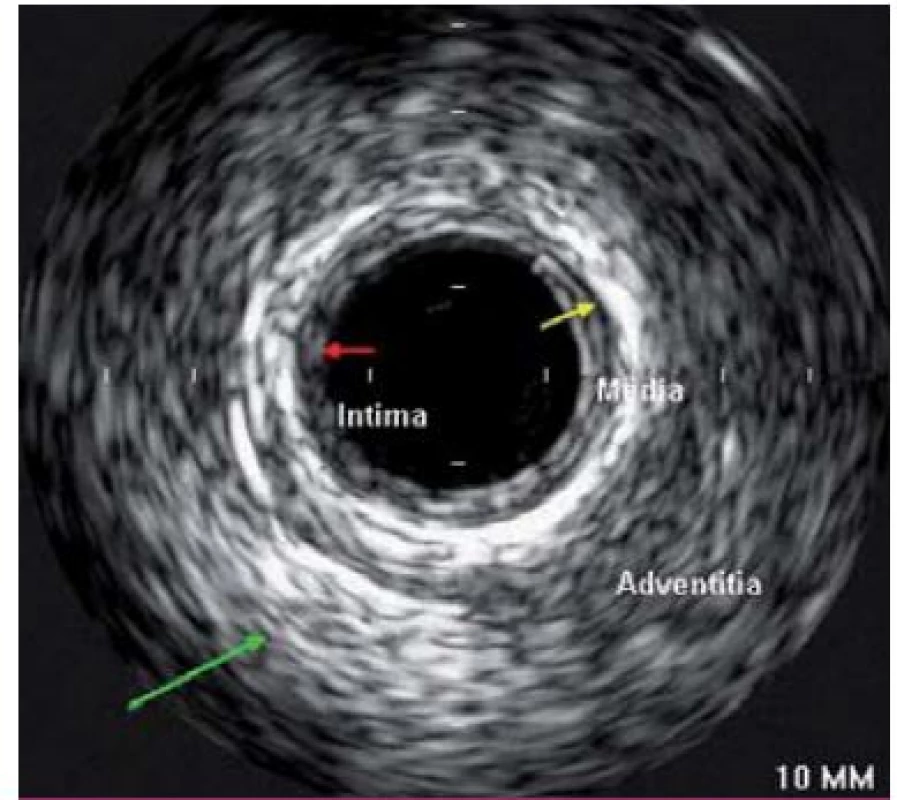 IVUS – obraz věnčité tepny s jednotlivými vrstvami cévní stěny: intima, medie a adventicie.
