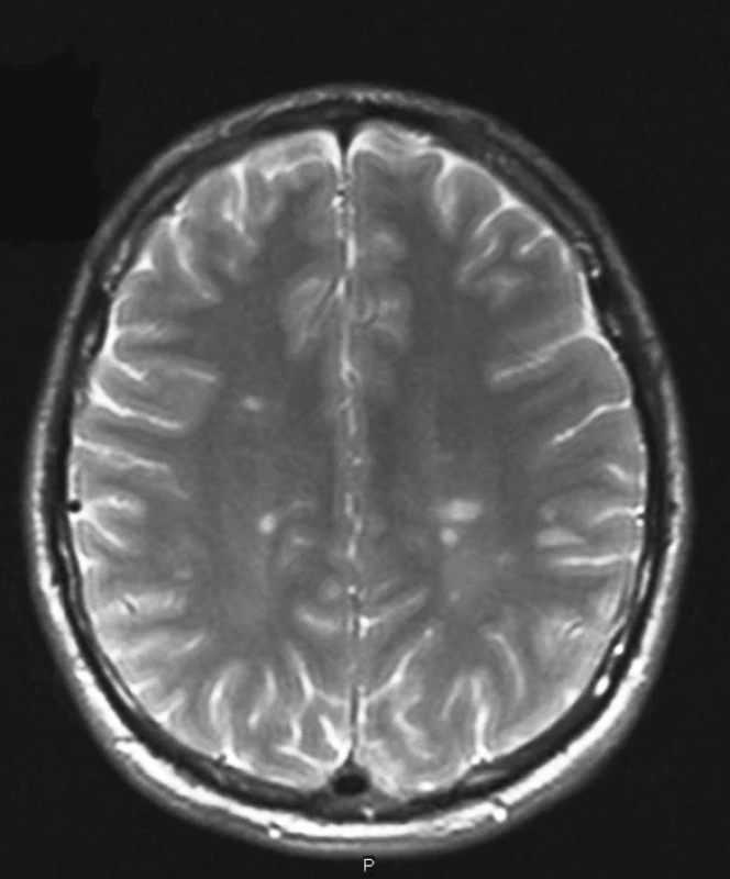 Typický MRI nález u RS.
(Zapůjčeno z oddělení magnetické rezonance Nemocnice na Homolce.)