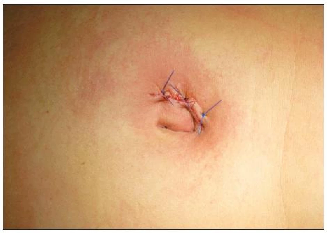 Operační rána
Fig. 5. Surgical wound
