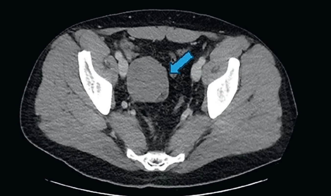 Objemný tumor malé pánve se zavzatým pravostranným ureterem na CT. A voluminous tumor of the small pelvis with an occluded right-sided ureter on CT.