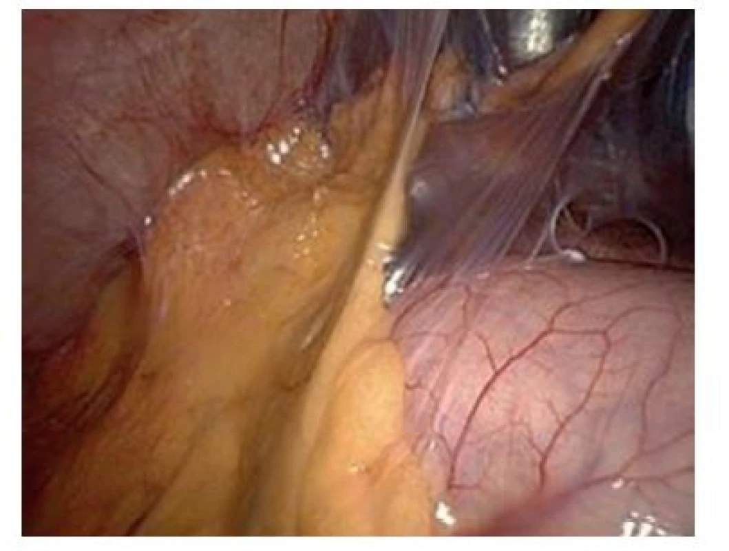 Laparoskopický pohled do podjaterní krajiny po punkční cholecystostomii
Fig. 3: Subhepatic space after percutaneous cholecystostomy – laparoscopic view