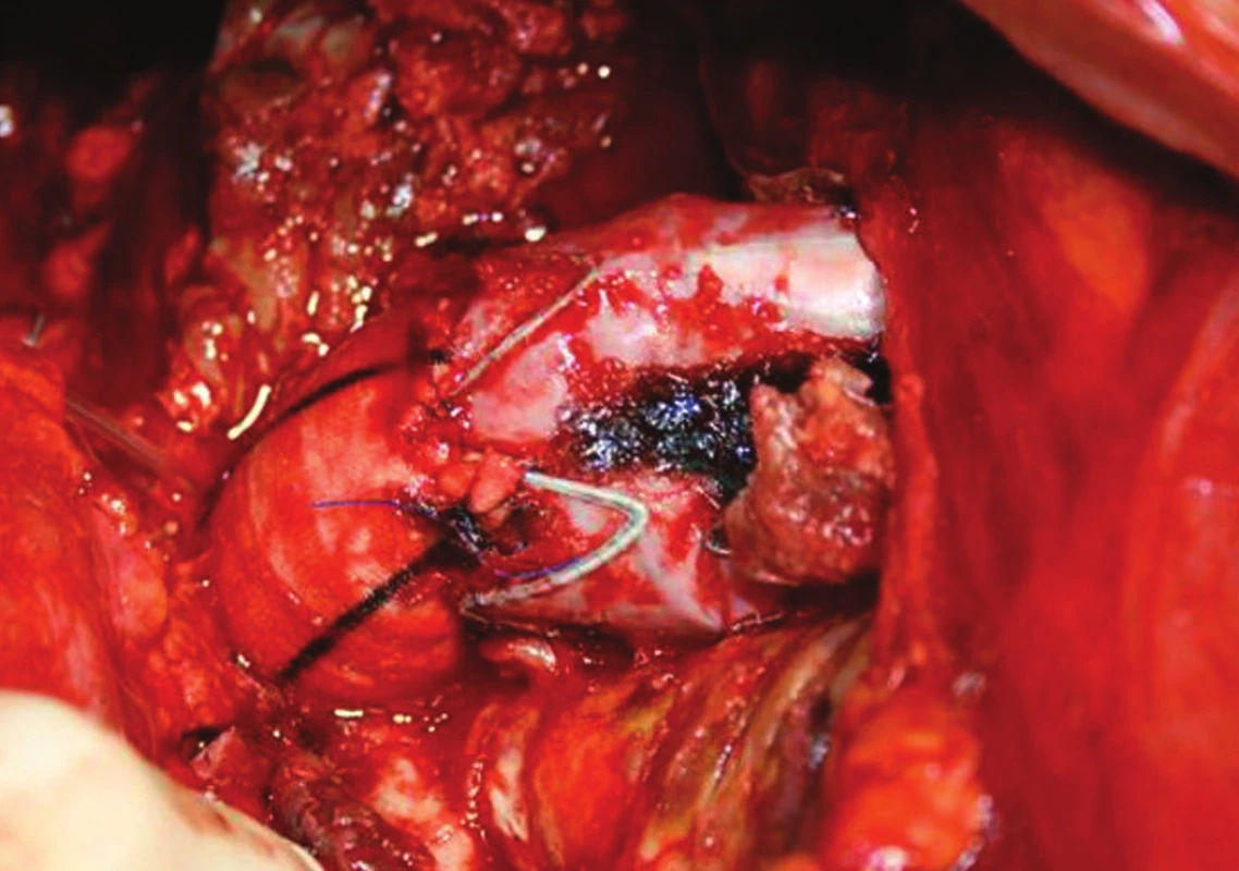 Resekce proximální části stentgraftu s využitím jeho distální části
Fig. 4: A resection of the proximal stentgraft using its distal portion
