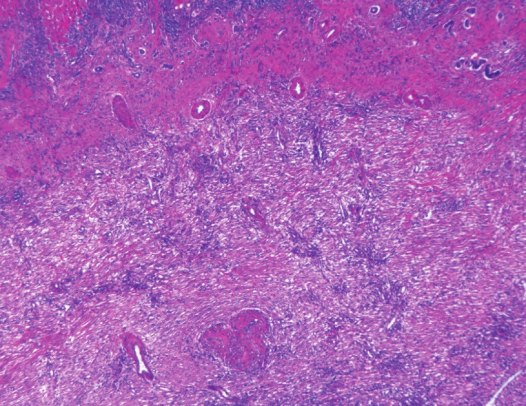 Fibroproduktivní změny navazující na pseudoabscesové ložisko a granulomatózní zánět pod lůžkem žlučníku
Fig. 5: Fibroproductive changes followed by pseudoabscess and granulomatous inflammation bellow gall bladder bed