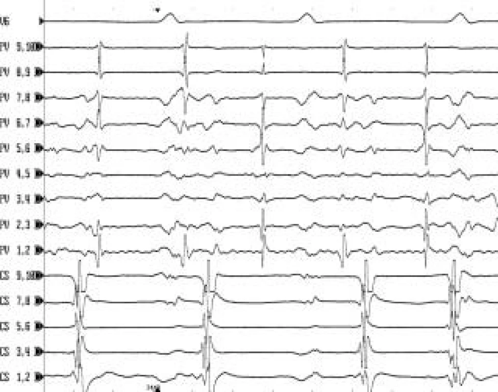 Intrakardiální EKG záznam u pacienta s fokální tachykardií z levé horní plicní žíly.
V intrakardiálním záznamu snímaném 10polárním cirkulárním katétrem v levé horní plicní žíle (PV 1,2–PV 9,10) běží pravidelná síňová tachykardie (ostré potenciály), která se z plicní žíly nepropaguje na levou síň v sekvenci 1 : 1. Výsledkem je nepravidelná aktivace levé síně (viz záznam z koronárního sinu CS 1,2–CS 9,10). Katetrová ablace u pacientů s fokální tachykardií z plicní žíly se provádí metodou izolace plicní žíly pomocí obkružující radiofrekvenční léze podobně jako u pacientů s fibrilací síní. Rychlost posunu EKG záznamu je 200 mm/s.
