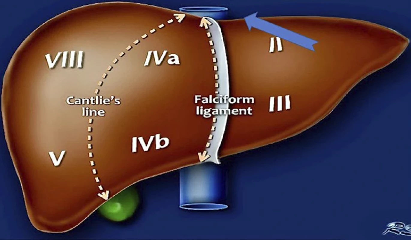 Schematický anatomický obrázek jaterního parenchymu s šipkou ukazující místo největšího krvácení. Zdroj [12].
