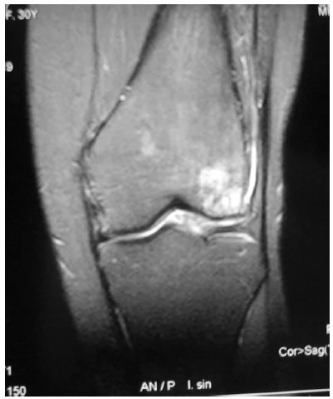 Magnetická rezonancia v koronárnej rovine – osteochondrálny defekt laterálneho kondylu