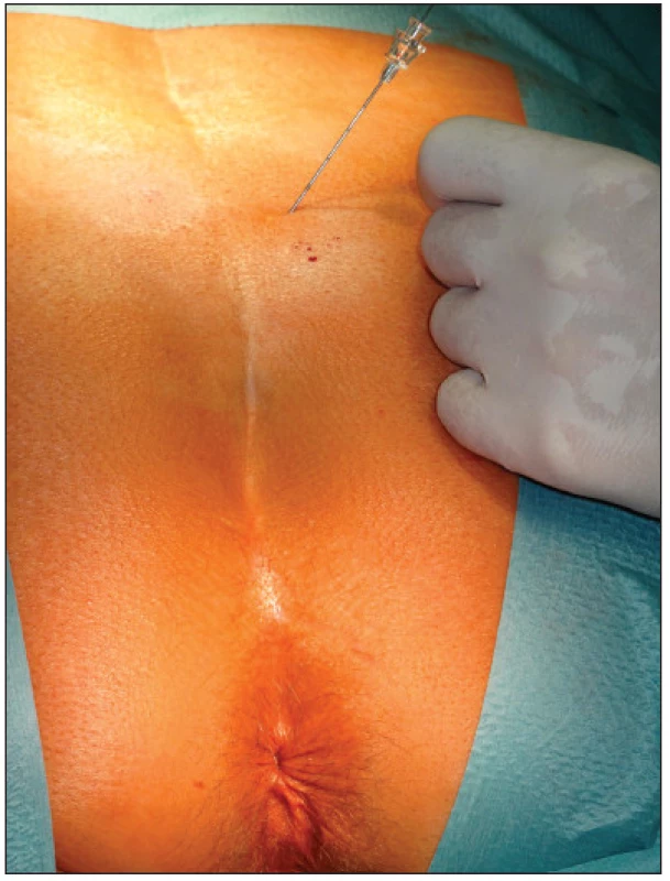 Perkutánní vyšetření nervu stimulační jehlou
Fig. 1. Percutaneous examination of the nerve with a stimulation needle