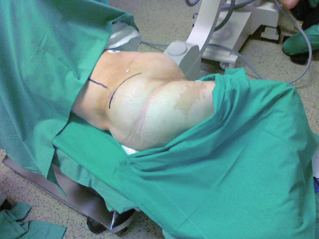 Varianta modifikované supinační polohy (snožené dolní končetiny)
Fig. 4. Variant of modified supine position (with legs put together)