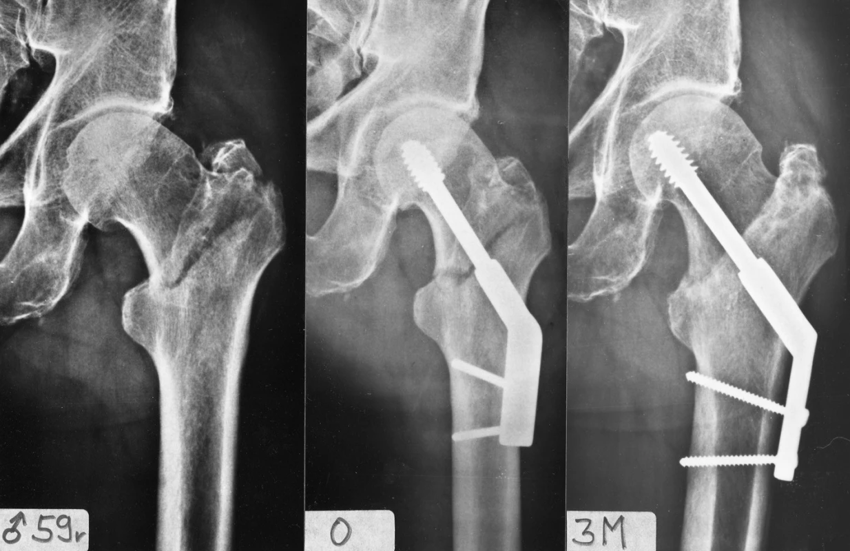 Osteosyntéza pertrochanterické zlomeniny pomocí DHS s 2otvorovou dlahou: a – stabilní pertrochanterická zlomenina; b – rtg po operaci; c – zhojení zlomeniny 3 měsíce po operaci.
Fig. 3: Internal fixation of a pertrochanteric fracture by DHS with a 2-hole plate: a – a stable pertrochanteric fracture; b – postoperative radiograph; c – fracture healed 3 months after operation.