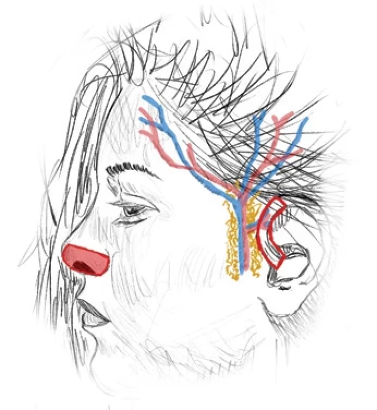Helix free fl ap to replace the missing nasal ala. (Drawing by A. Berkeš).
