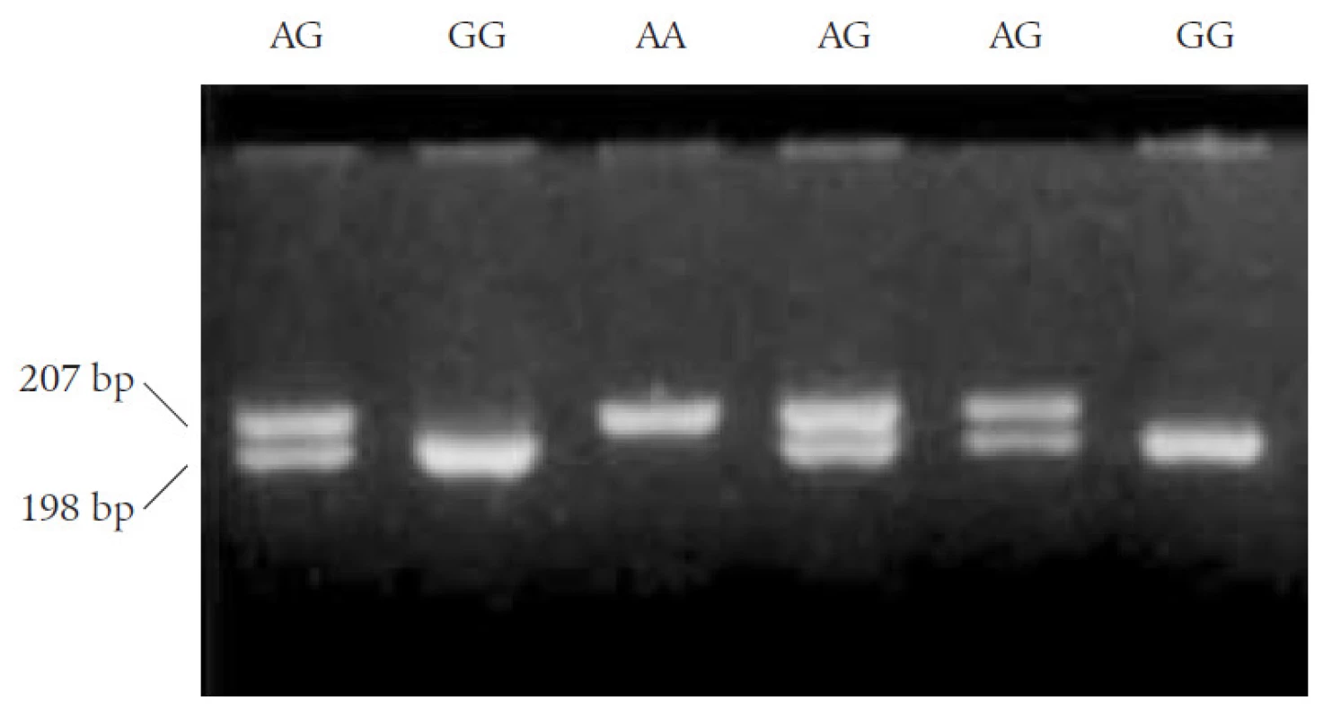 Genotypy polymorfizmu Arg16Gly genu pro β<sub>2</sub>-adrenergní receptor, Arg16 (wild type) fragment 207 bp genotyp AA homozygot, Gly16 (polymorfizmus, záměna adeninu za guanin v sekvenci DNA jediného exonu, vznik restrikčního místa pro NcoI restrikční enzym), genotyp GG homozygot, fragment DNA o 189 + 18 bp, genotyp AG heterozygot B2AR genu detekován na 3% agarózovém gelu jako dva fragmenty o 207 a 189 bp.