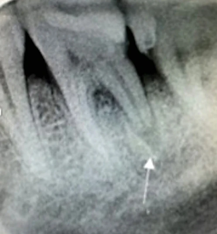 Externá zápalová resorpcia distálneho koreňa zuba 36 u pacienta s prebiehajúcou apikálnou periodontitídou. Zdroj: Simona Fritzká. Fig. 3 External inflammatory root resorption of a distal root of tooth 36 in patient with apical periodontitis. Source: Simona Fritzká.