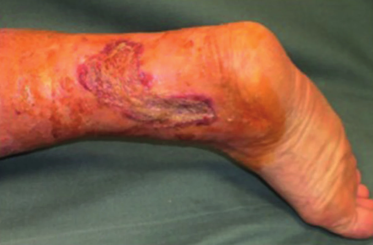 Pacient č. 1 −15. den po dermoepidermální transplantaci bez PRP – 90 % defektu zhojeno
Fig. 5: Patient No. 1 − 15 days after transplantation without PRP – 90% of the defect healed
