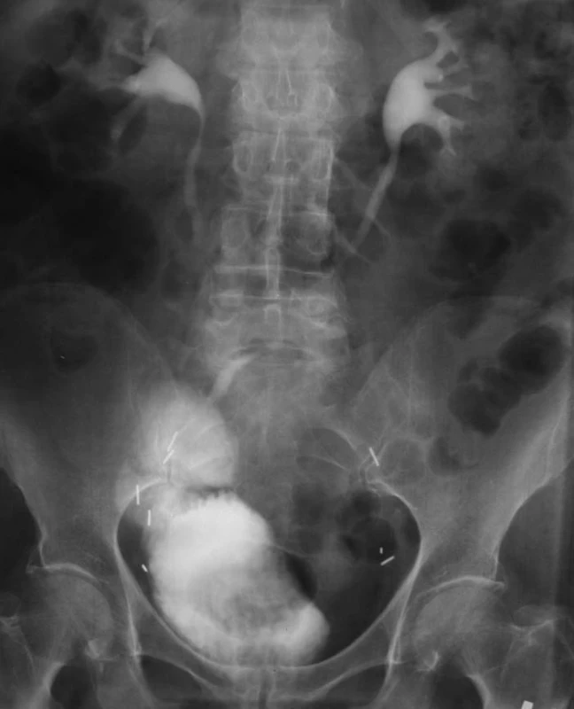 Ortotopická neovezika u muže – vylučovací urografie.