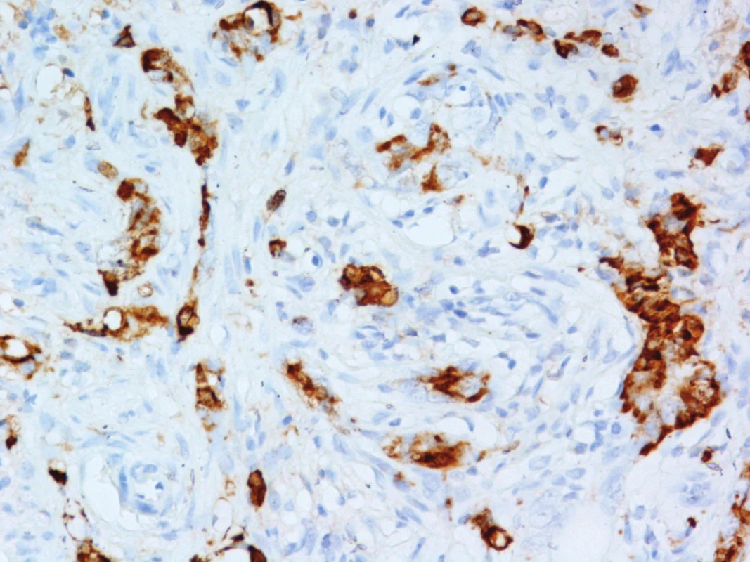 Pozitivita nádorových buněk v imunohistochemickém průkazu Chromograninu A (Originální zvětšení 400x)
Fig. 6: Tumour cells positivity based on immunohistochemical analysis of chromogranin A (Original magnification 400x)
