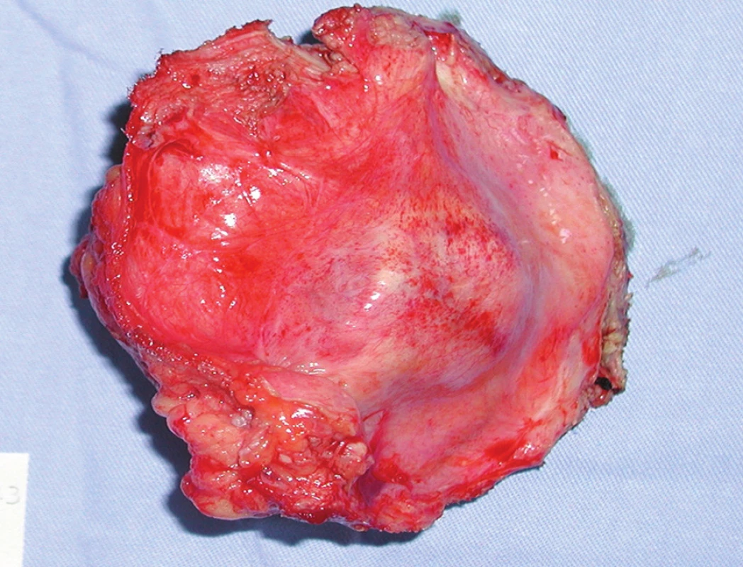 Exstirpovaná metastáza adenokarcinómu do brušnej steny
Fig. 2. Exstirpated metastasis of adenocarcinoma into abdominal wall
