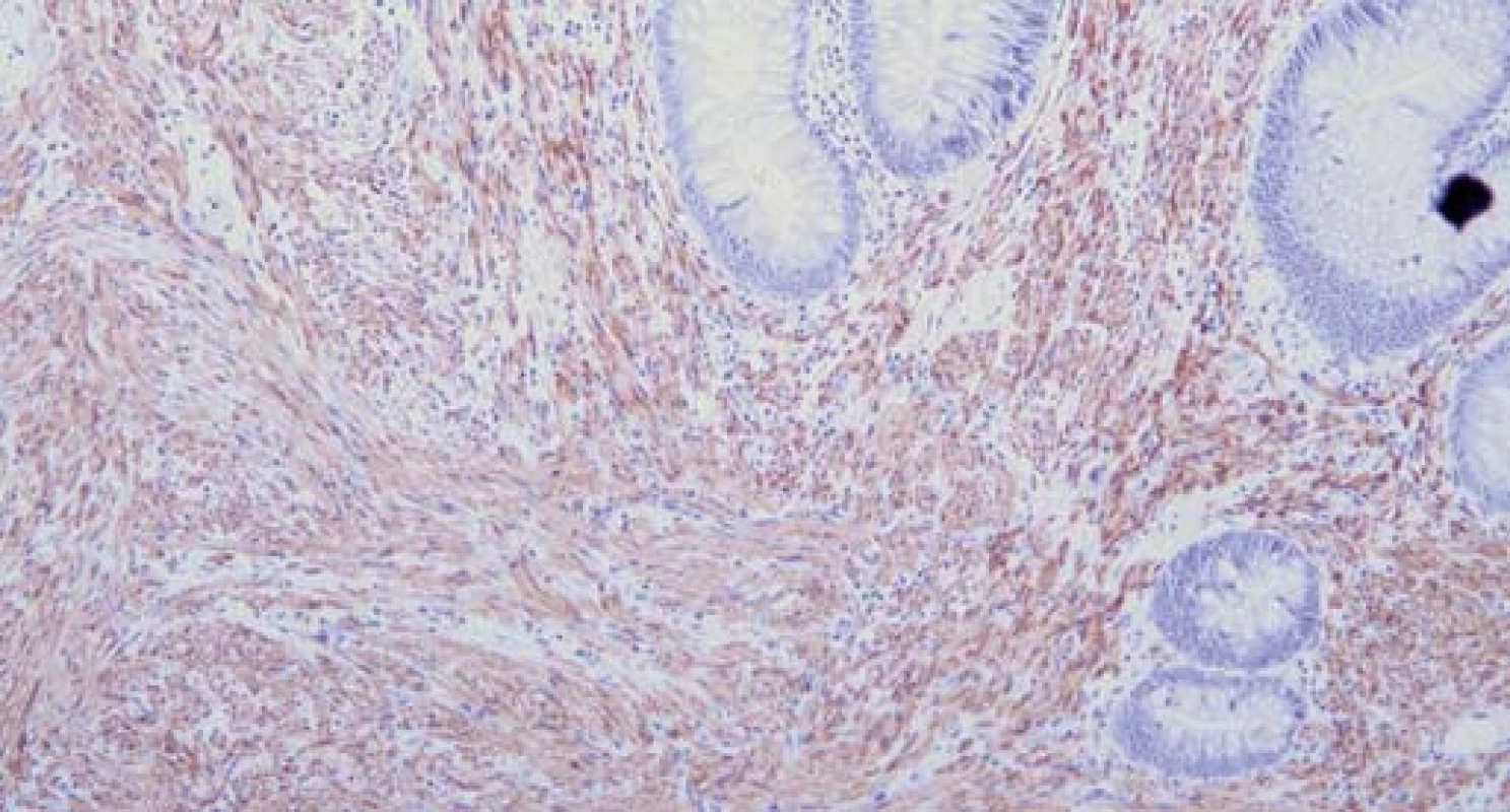 Speciální imunohistologické vyšetření S100 protein, zvětšeno 200×.