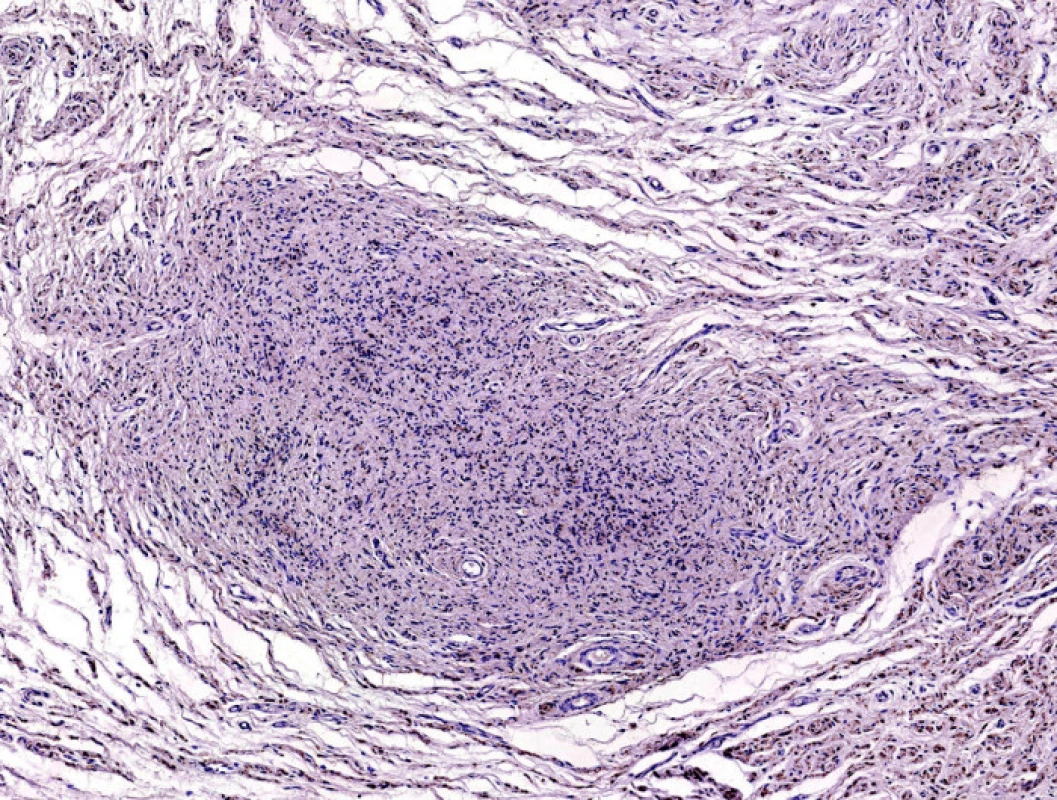 Neurofibrom, S-100 protein, původní zvětšení 40x.
