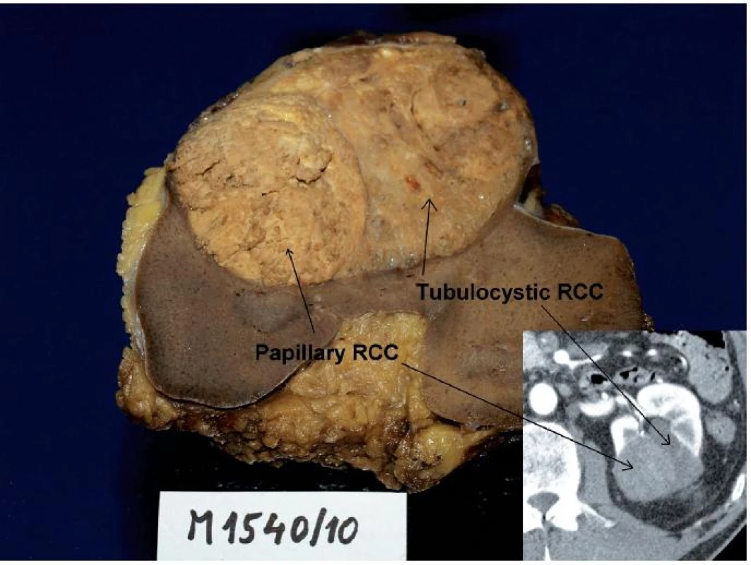 Muž 68 let, tumor levé ledviny T1bN0M0, histologicky se jednalo o tubulocystický renální karcinom s jasně odděleným ložiskem papilárního renálního karcinomu, což bylo možné zpětně identifikovat na CT (vpravo dole). 
Fig. 2. Sixty eight year old man, tumour of the left kidney T1bN0M0. Histologically, tubulocystic RCC with clearly visible locus of papillary RCC. The tumour could be retrospectively identified on CT as well. 