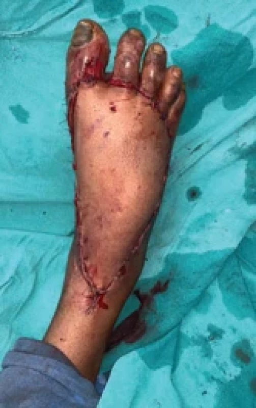 Anterolateral thigh fl ap sugar monitored with a glucometer.