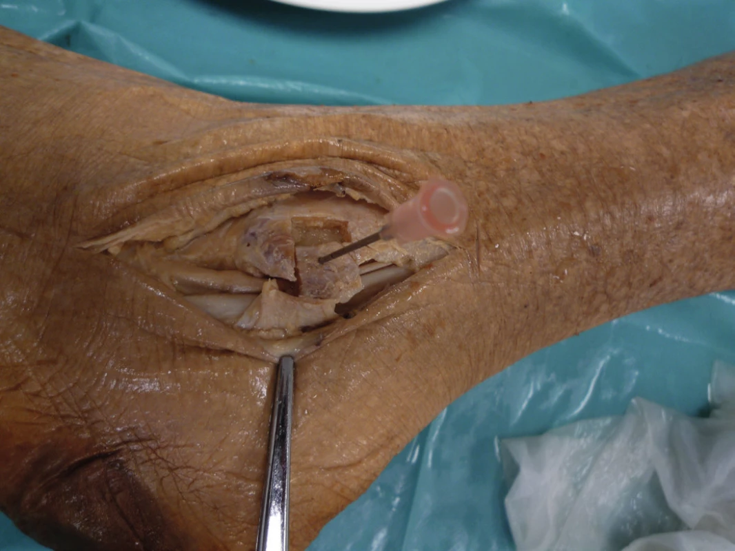 „Bone block procedure“, s patrným SPR, dočasně přerušeným
