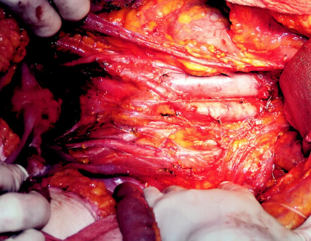 Subtotální proktokolektomie s radikální lymfadenektomií a zachováním vegetativních plexů
Fig. 1. Subtotal proctocolectomy with radical lymphadenectomy and preservation of vegetative plexus
