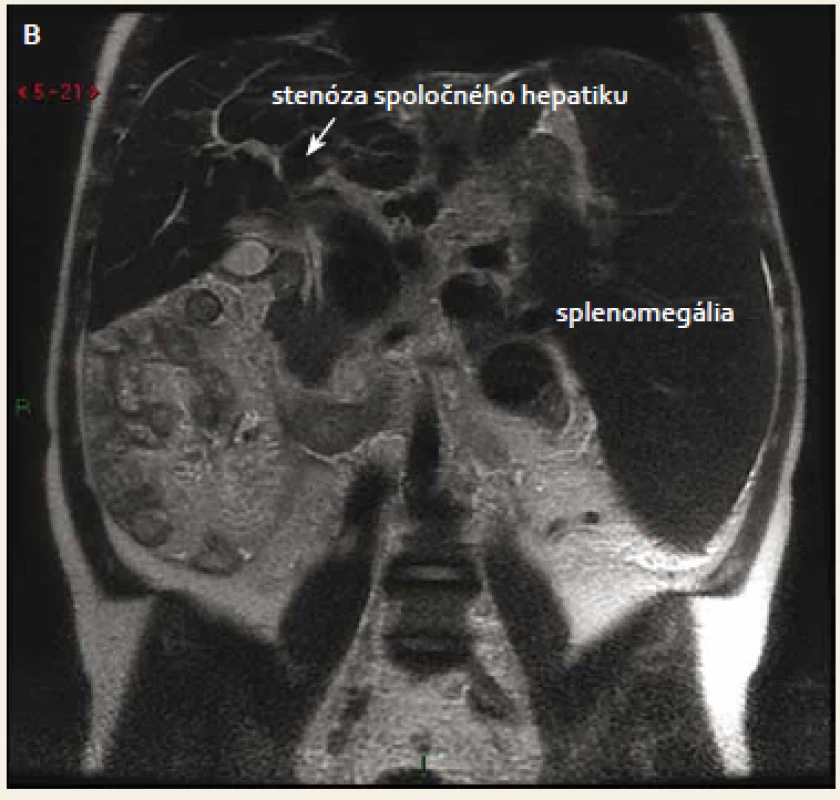 MRCP pacienta z RTG oddelenia (FNsP F. D. Roosevelta, Banská Bystrica).
Fig. 1. MRCP of the patient from X-ray department (F. D. Roosevelt University Hospital with Polyclinic, Banská Bystrica).
