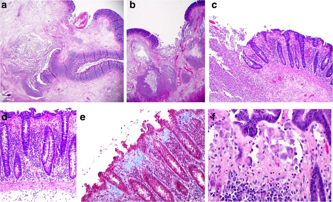 Microscopy of the resected colon: a and b Low power views (×12.5) of ulcerated bowel with abscess formation and transmural necrosis. Even at this low magnification the non-ulcerated mucosa shows clear evidence of collagenous colitis. c Medium power view (×100) of mucosal ulceration (left) and severe collagenous colitis (right). d High power view (×200) of the mucosa showing the features of collagenous colitis: a markedly thickened subepithelial collagen layer measuring up to 100 μm, surface epithelial flattening with loss of goblet cells, separation of the epithelium from the lamina propria, increased intraepithelial and lamina propria chronic inflammatory cells. e High power view (×200), Masson's trichrome stain, in which the thickened subepithelial collagen layer is stained blue. f Very high power view (×400) of multinucleated histiocytes