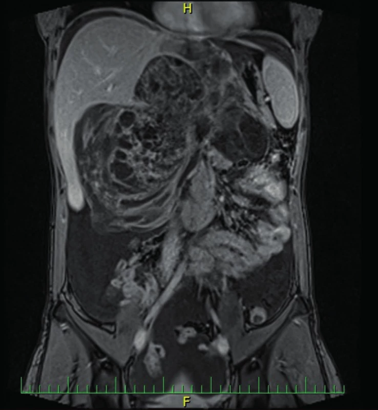 MR břicha 16. 5. 2014
Fig. 1: Abdominal MRI 16. 5. 2014