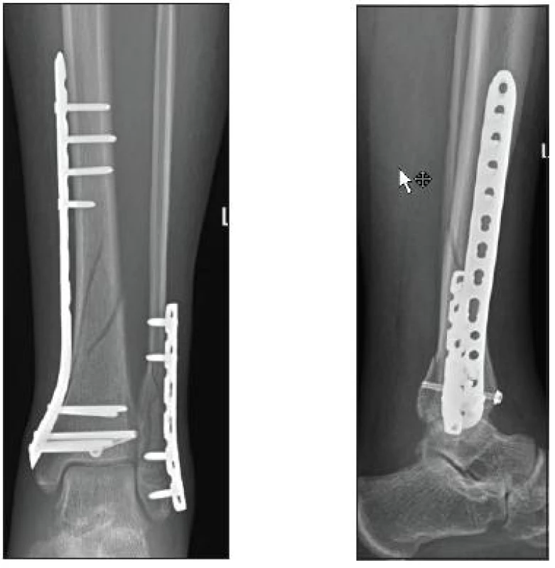 Osteosyntéza mediální 3,5 mm LCP dlahou (KÚCH)