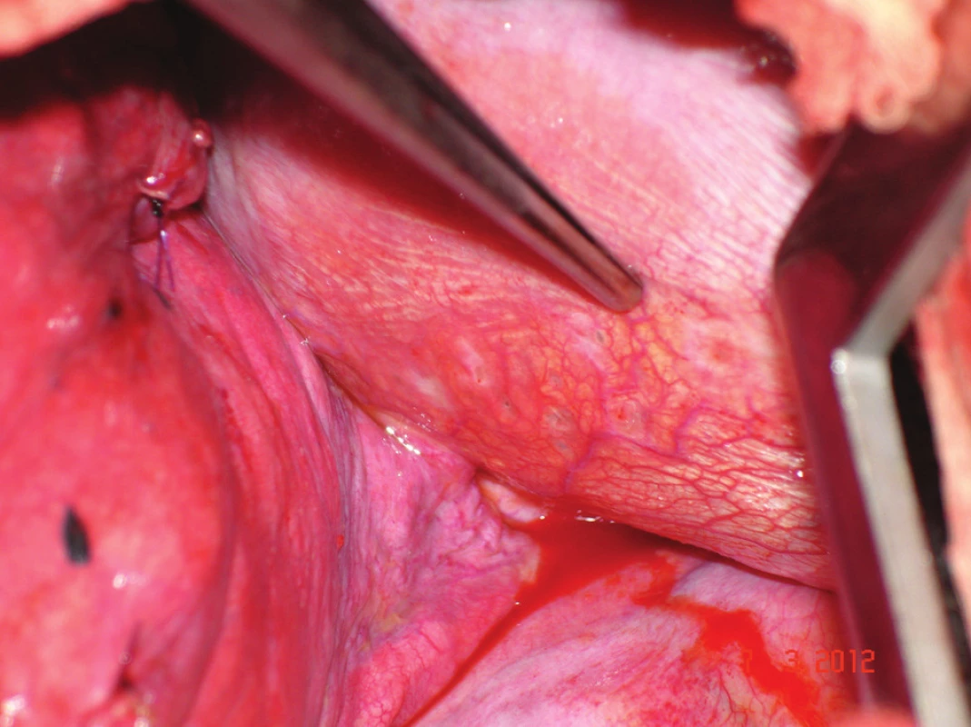 Vícečetné otvory v šlašitém centru bránice jako příčina recidivujícího katameniálního pneumotoraxu – operační foto
Fig. 1: Multiple holes in the tendinous area of the diaphragm as the cause of recurring catamenial pneumothorax – photo from the operation