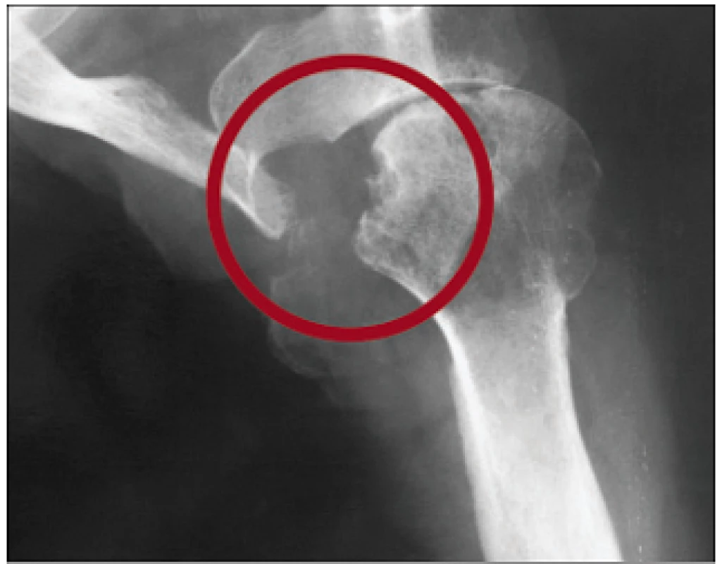 Destruktivní artropatie při dialyzační amyloidóze z ukládání β<sub>2</sub>-mikroglobulinu.