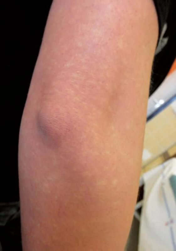 Pseudoleucoderma angiospasticum