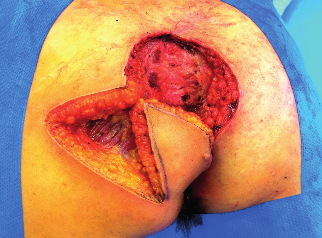 Stav po excizi a příprava laloku
Fig. 4: Finding after excision and preparation of the flap