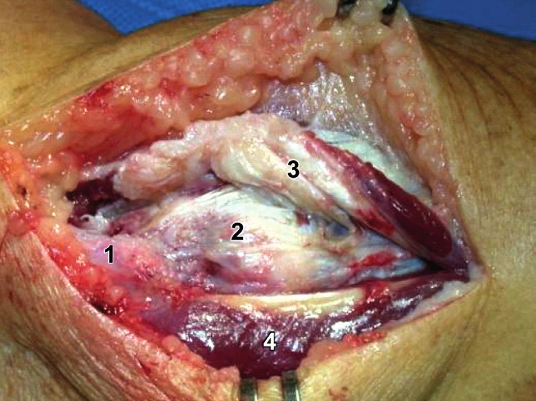 Modifikovaný Kocherův přístup – uvolnění m. extensor carpi ulnaris: 1 – epicondylus lateralis humeri, 2 – kloubní pouzdro zesílené lig. collaterale lat. a lig. anulare radii, 3 – uvolněný a odtažený m. extensor carpi ulnaris, 4 – m. anconeus s dobře patrnou typickou šlachou.
Fig. 9: Modified Kocher approach – release of the extensor carpi ulnaris: 1 – lateral epicondyle of humerus, 2 – joint capsule reinforced by lateral collateral ligament radial annular ligament, 
3 – released and retracted extensor carpi ulnaris, 4 – anconeus with a typical tendon.
