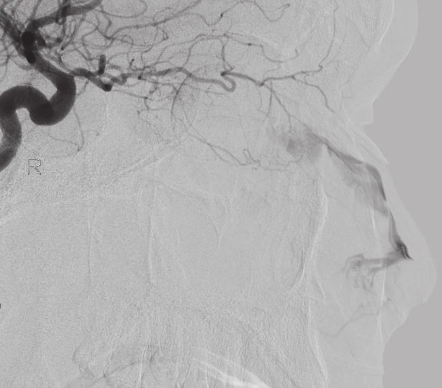 Angiografie: extravazace z a. ethmoidalis anterior vpravo.