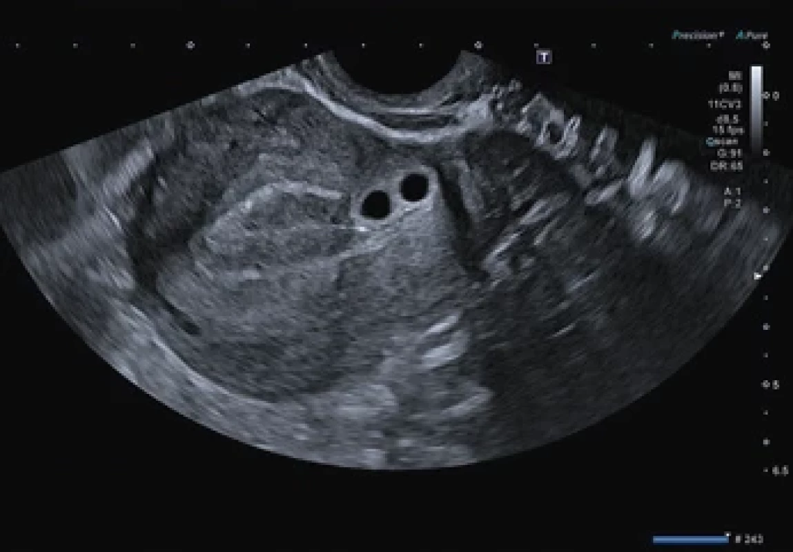Na ultrazvuku jsou patrné dva gestační váčky nad děložním isthmem, bez struktur plodového vejce, odpovídající 5+4 (8,2 mm) a 5+2 (5,4 mm) týdnu těhotenství. Fig. 1. Ultrasound shows two gestational sacs above the uterine isthmus, without fetal structures identifi ed, corresponding to 5+4 (8.2 mm) and 5+2 (5.4 mm) weeks of pregnancy.