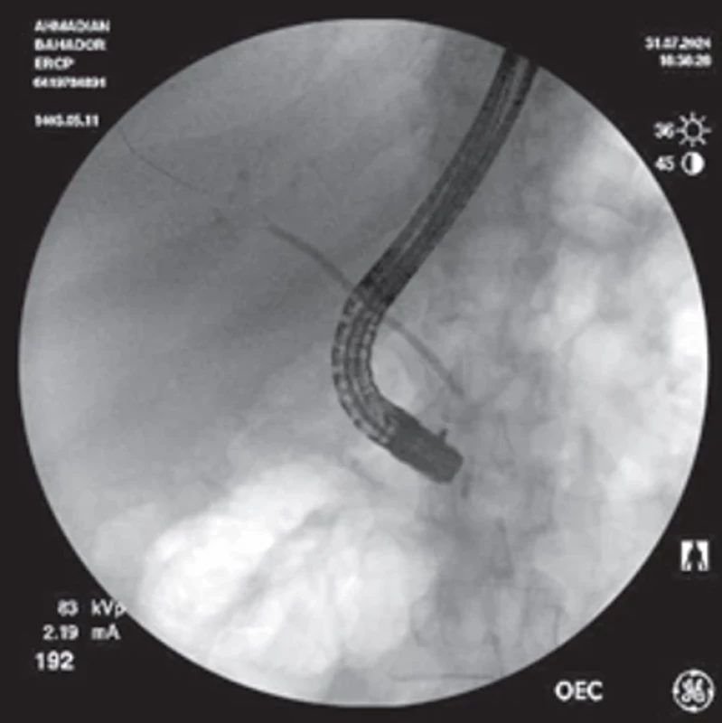 Fluoroscopic image showing a severe pancreatic duct  stricture before dilation (patient 1, 50-year-old male with chronic  pancreatitis). A 3-mm coronary balloon was used for dilation,  followed by the placement of a 6-Fr pigtail stent. Obr. 1. Skiagrafický nález ukazuje závažnou strikturu pankreatického vývodu před dilatací (pacient ,50. letý muž s chronickou pan kreatitidou). K dilataci byl použit 3mm koronární balónek a následně byl zaveden 6-Fr pigtail stent.
